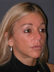 Mid Facelift - Patient 7 - Obl Right - After